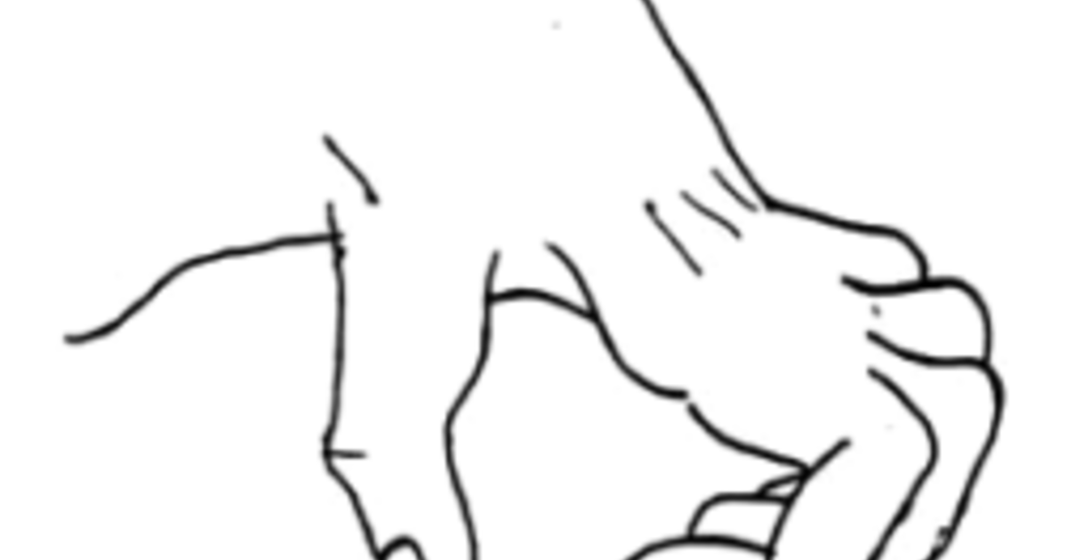 Hội chứng Volkmann - Hình ảnh minh họa